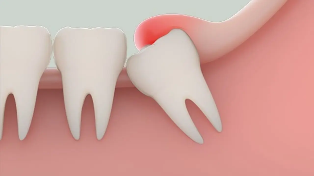 Tổng quan về răng khôn và khi đau phải làm gì