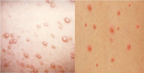 So sánh bệnh thủy đậu và chân tay miệng ở trẻ