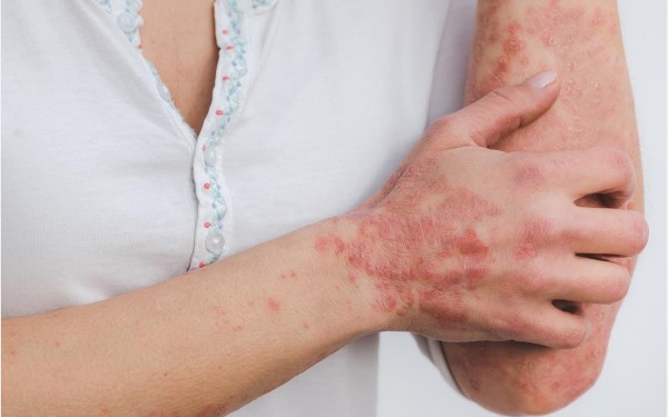 Bệnh vảy nến: Nguyên nhân, triệu chứng và cách điều trị