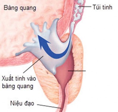 Điều trị xuất tinh ngược dòng và hiếm muộn ở nam giới